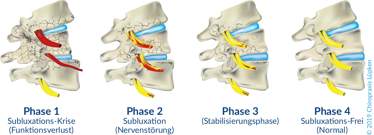 Chiropraktik in der Schwangerschaft - Subluxation und Normalzustand eines Wirbelkörpers